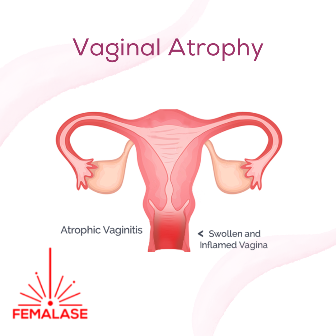 Navigating Vaginal Atrophy with Confidence and Knowledge - Picnob