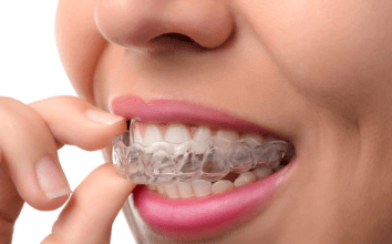 Clear Aligners: A Groundbreaking Innovation in Orthodontics