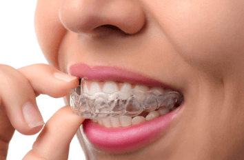 Clear Aligners: A Groundbreaking Innovation in Orthodontics