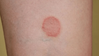 Lyme Disease:_Jfclz00o-Q= Ringworm Rash