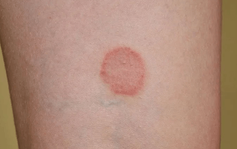 Lyme Disease:_Jfclz00o-Q= Ringworm Rash