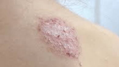 Eczema:7acnpkb0dii= Ringworm