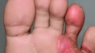 Fungus:Dudl8ndc8ka= Feet