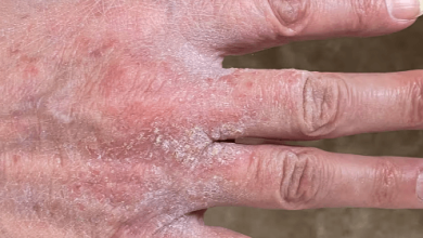 Rash:Bits0b_Vaiu= Scabies