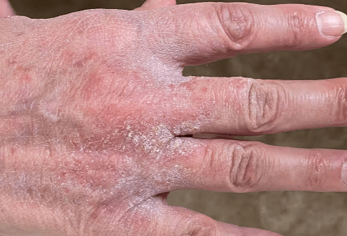 Rash:Bits0b_Vaiu= Scabies
