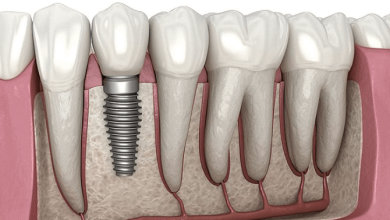 When do I Need Dental Implants?