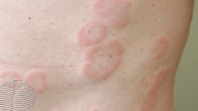 Rash:Ddugh6wldz0= Hives