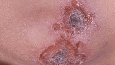 Skin:Hnxv_1hcbna= Impetigo