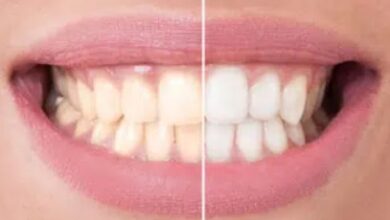 Teeth Color Restoration