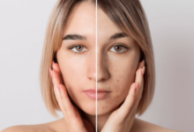 Transform Your Skin with Merz Aesthetics' Skin Tightening Solutions in Dubai