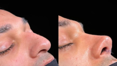       Which Area in Islamabad Is Famous for Rhinoplasty?