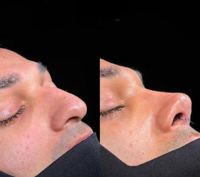 Which Area in Islamabad Is Famous for Rhinoplasty?